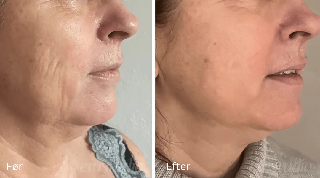 EMSHAPER FACE RESULTATER