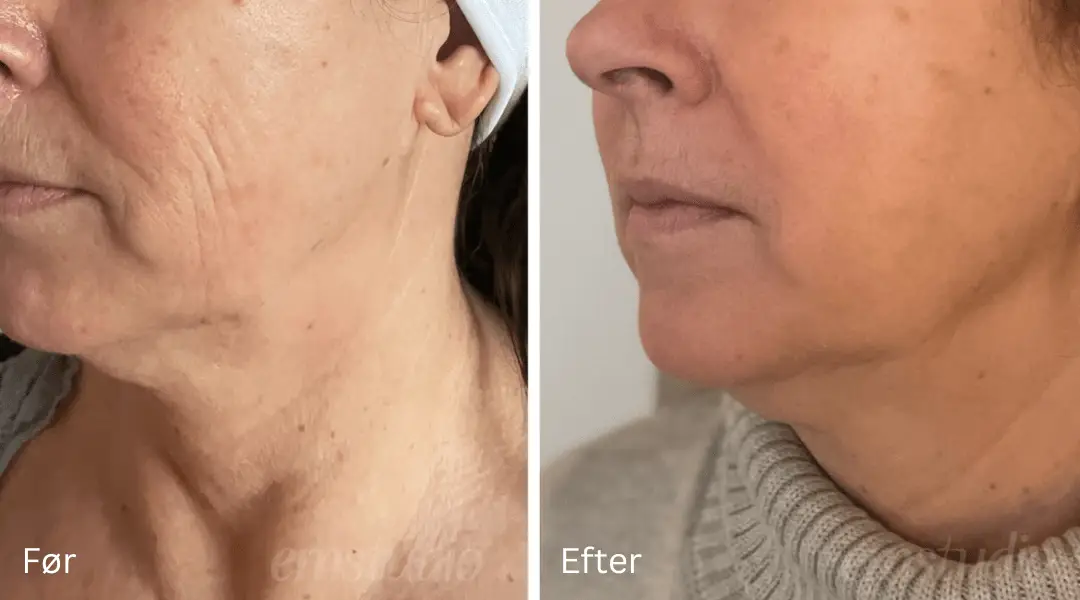 em face shaper resultatere