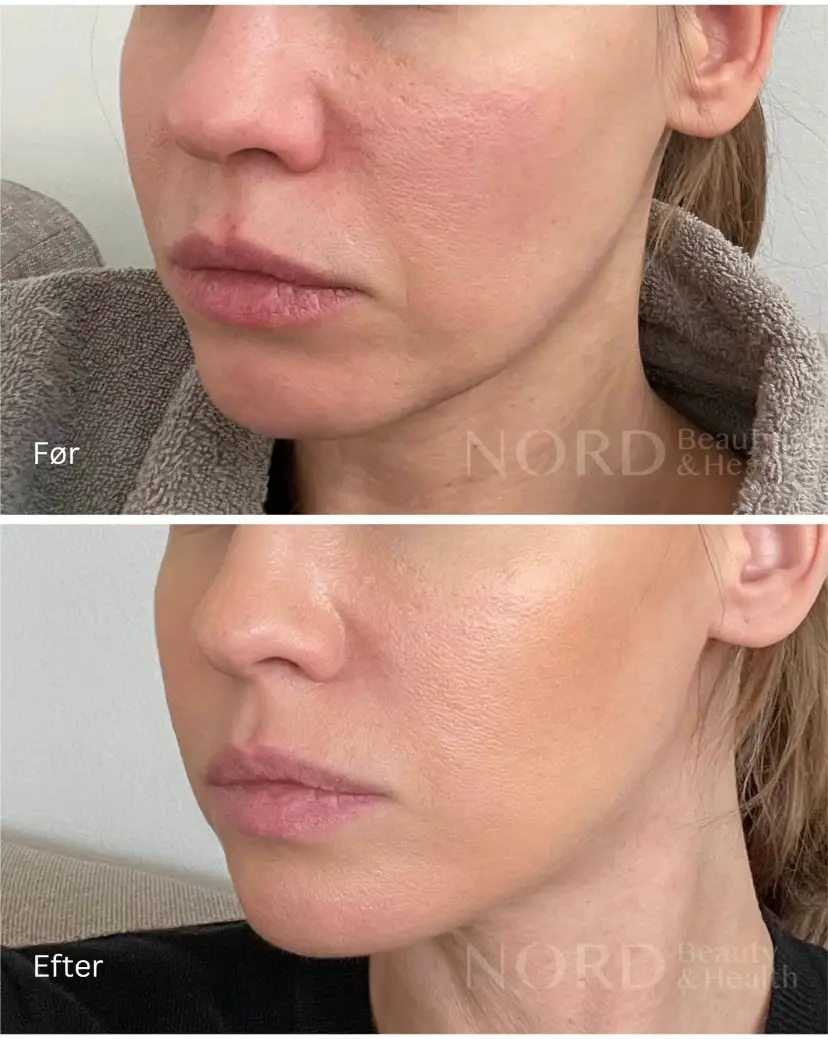 em face shaper resultater