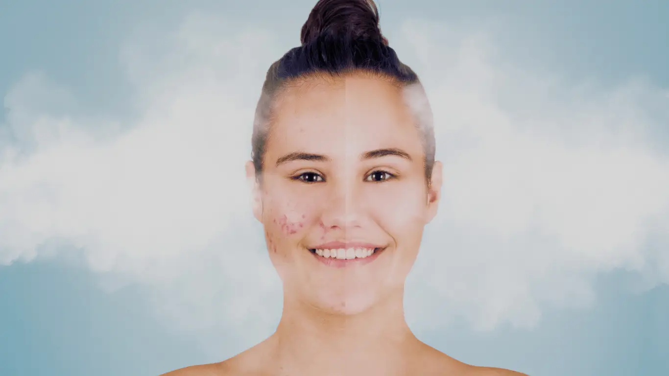 CRYO ACNE