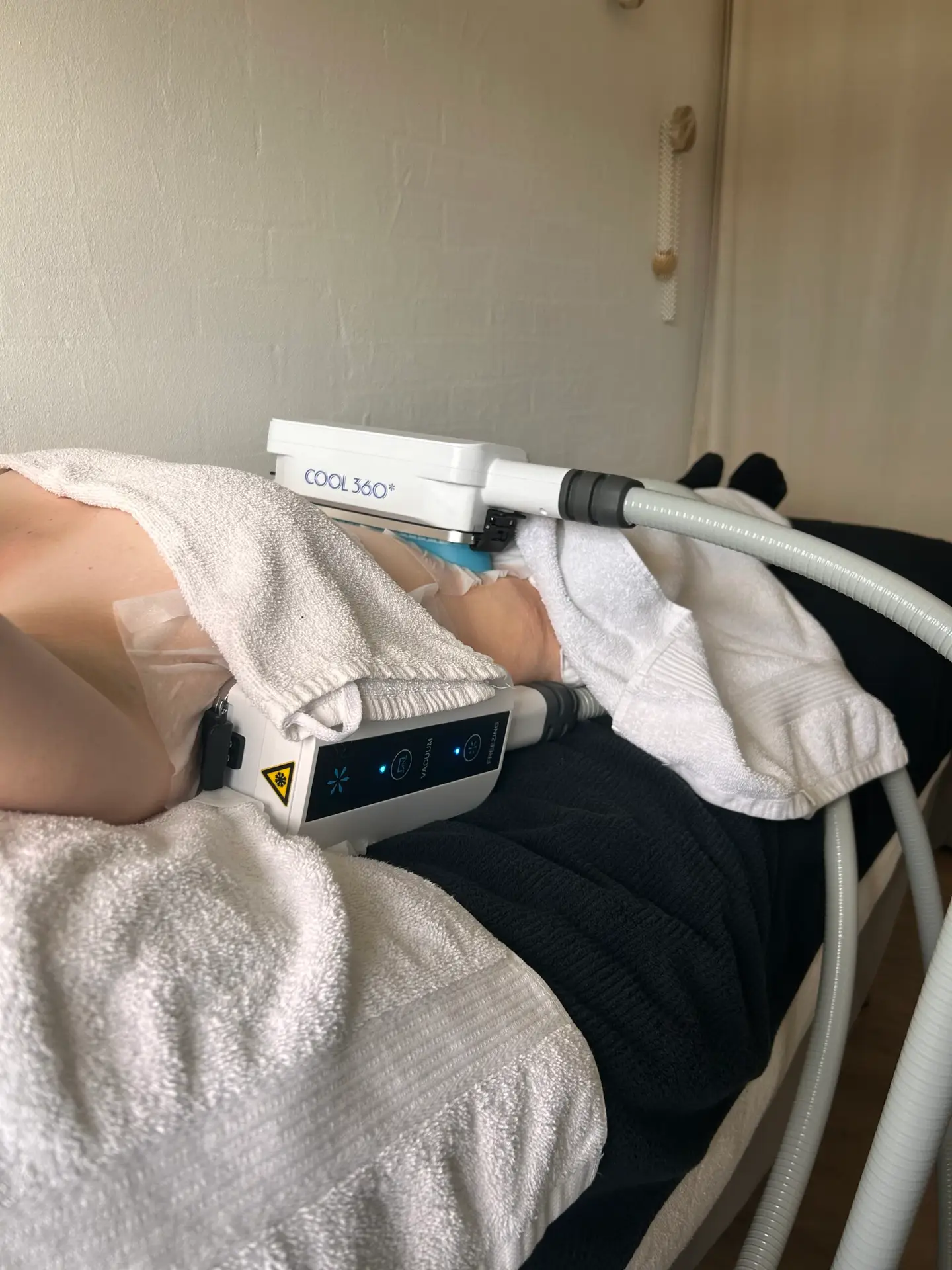 Fedtfrysning af lokale fedtdepoter omkring venusbjerget i Horsens