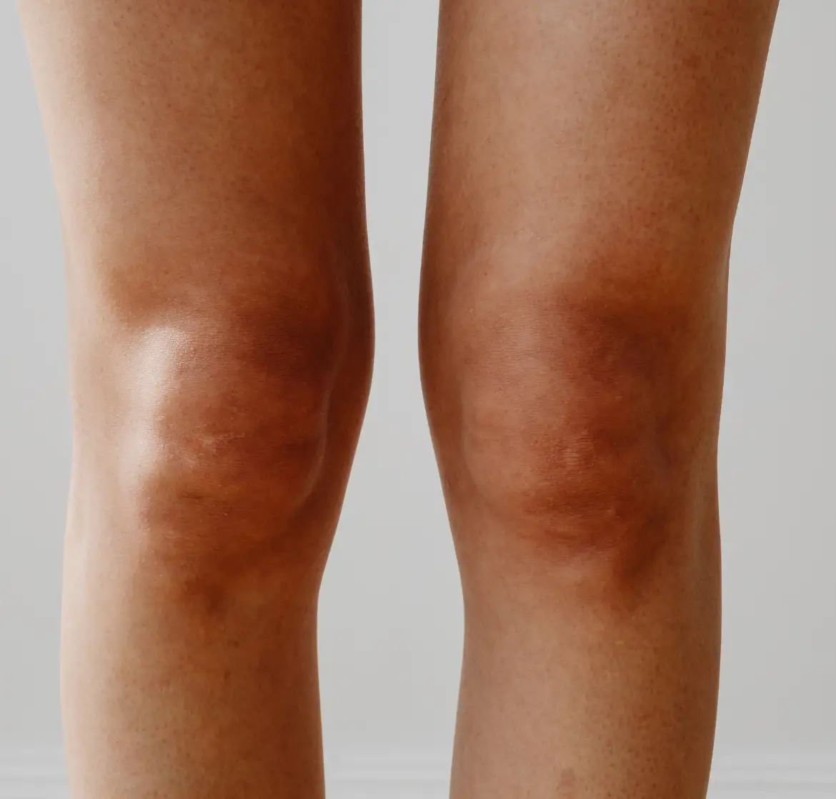 Fedtfrysning af lokale fedtdepoter ved knæ og knæfolder i Horsens